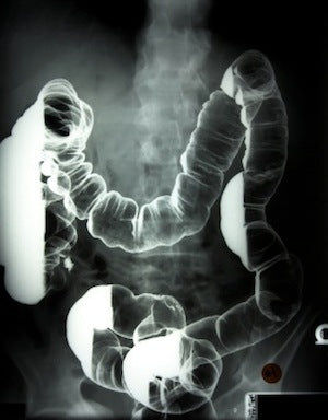 Colon X-ray with Barium