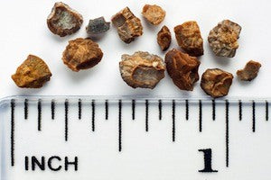 Kidney stones